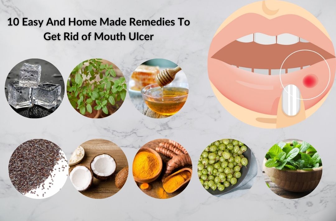 10 Easy And Home Made Remedies To Get Rid of Mouth Ulcer