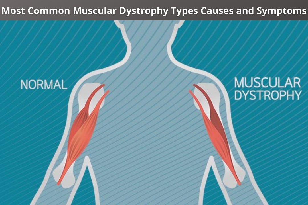 Most Common Muscular Dystrophy Types, Causes and Symptoms