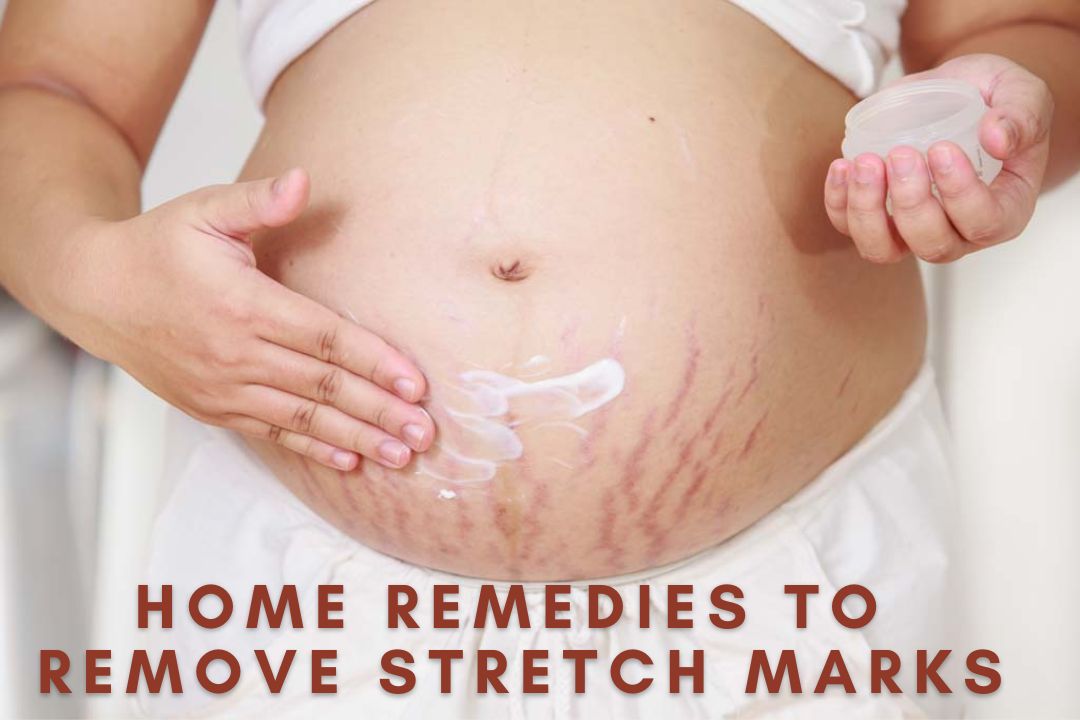 Home Remedies for Stretch Marks Using Almond Oil, Aloe Vera, and more